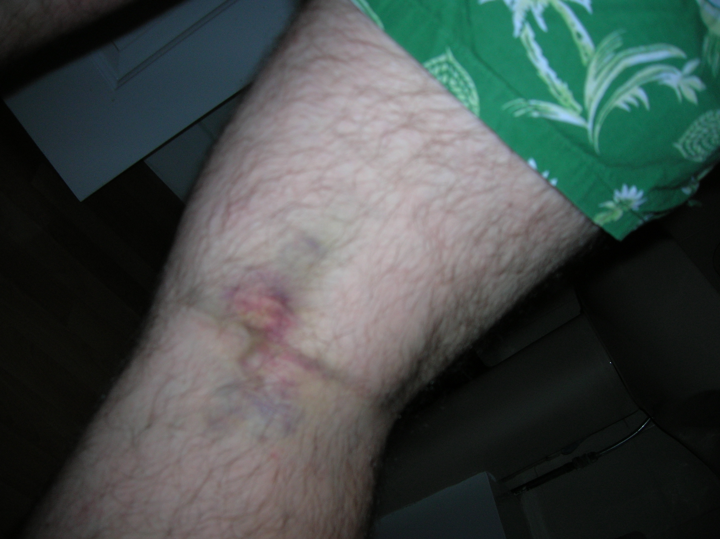 bruise varicose)